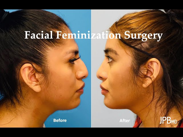 Facial Feminization Surgery