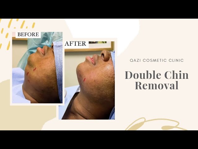 Double Chin Removal by Dr. Nadir Qazi