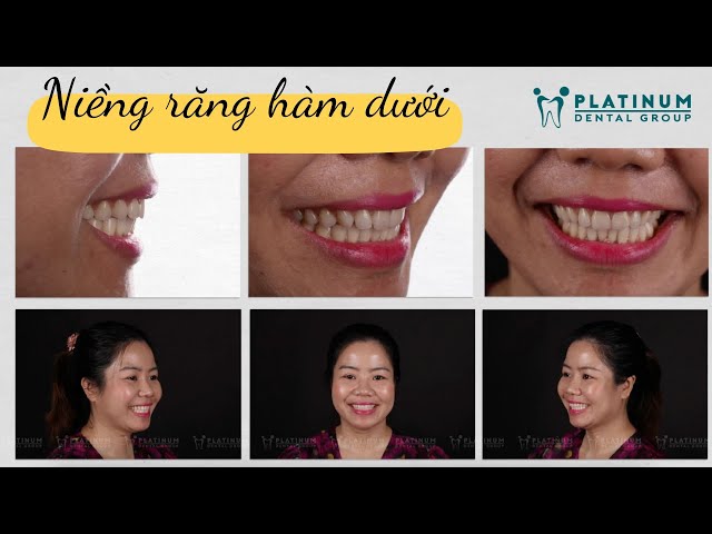 Niềng răng hàm dưới | Platinum Dental Group