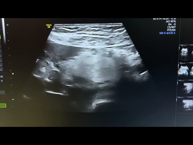 Ultrasound of panniculitis