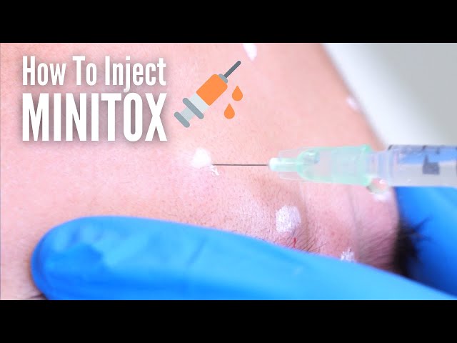 How I inject Minitox™(Using Botox, Xeomin, and Dysport)