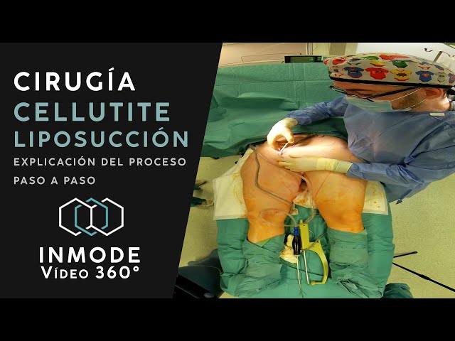 CIRUGÍA CELLUTITE LIPOSUCCIÓN - Explicacion del proceso paso a paso - Inmode 360 learning