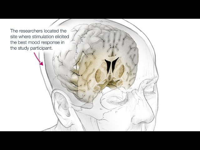 Personalized Deep Brain Stimulation Therapy (DBS)