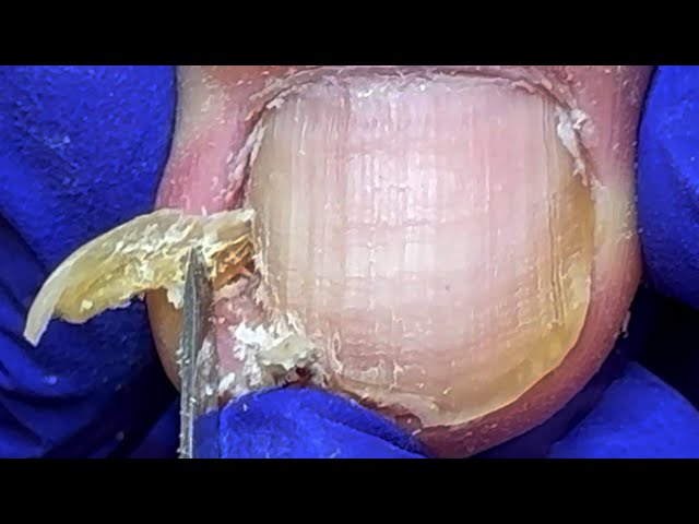 Crazy ingrown nails surrounded by yellow fungus【Doctor Liu Pedicure】