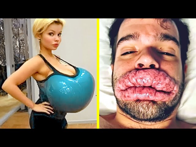 20 People Who Took Their Plastic Surgery Too Far