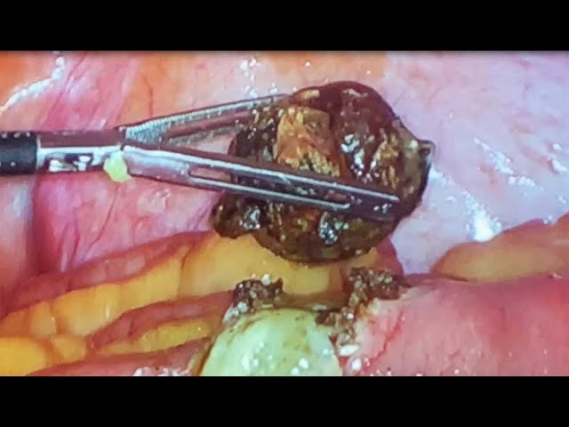 Laparoscopic Management of Gallstone Ileus by Dr. Iraniha