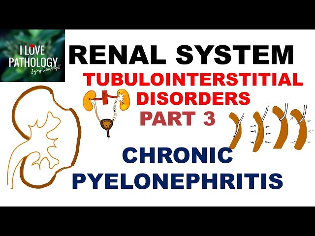 CHRONIC PYELONEPHRITIS - PATHOLOGY