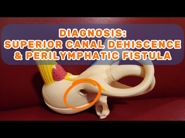 DIAGNOSIS: Superior Canal Dehiscence Syndrome & Perilymphatic Fistula - Dizzy Therapy