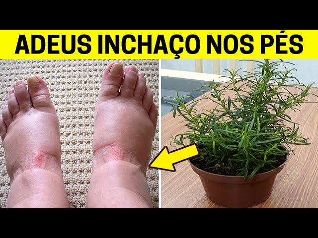 Remédio Natural Para VARIZES e Má Circulação nas Pernas e INCHAÇO com Apenas Dois Ingredientes