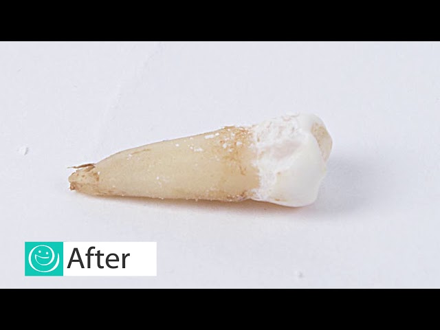 Tooth erosion experiment with Dr Ben Atkins