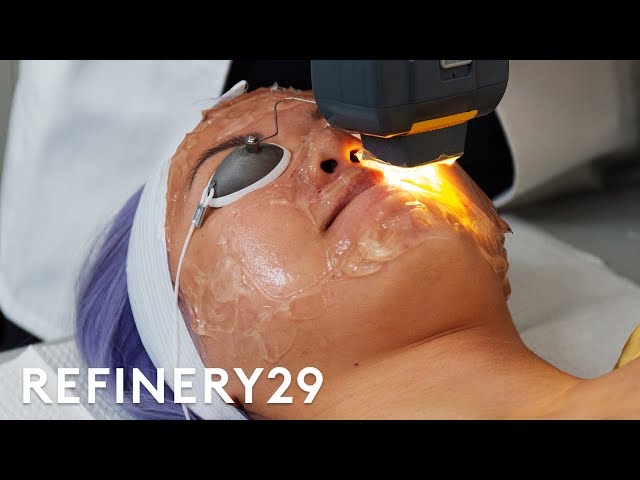 I Got The $65 Laser Facial For Acne | Beauty With Mi | Refinery29