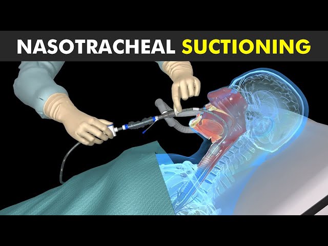 How Nasotracheal Suctioning Is Performed?