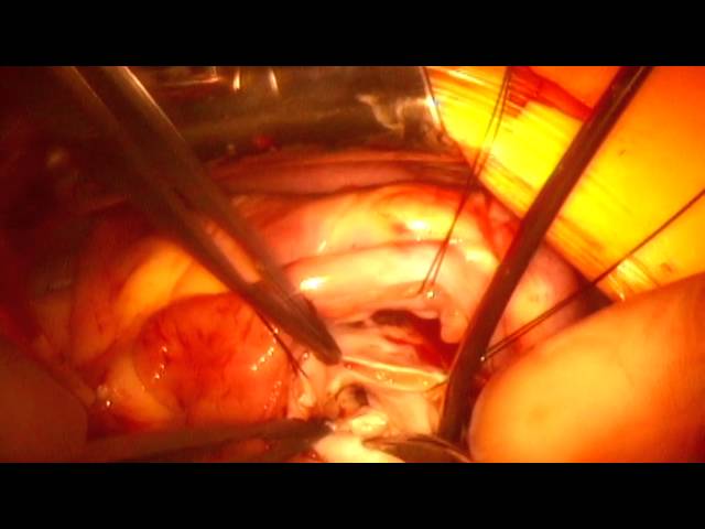 Heart Surgery to Repair Congenital Heart Defect - Dr. Emile Bacha