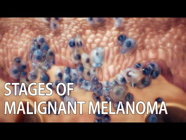 Malignant melanoma animation | skin cancer | #SkinCancer #MalignantMelanoma #MelanomaAwareness