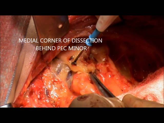 Axillary dissection during MRM- Electrosurgery Video- Dr Rajnish Talwar