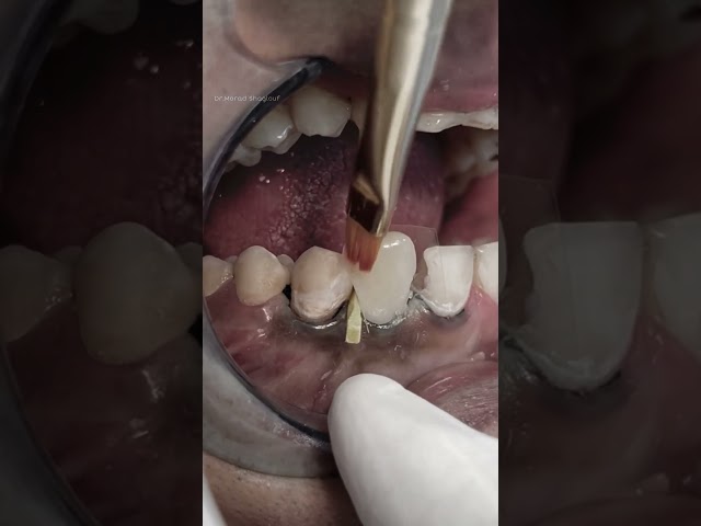 Composite and fiber post after Root canal treatment of anterior teeth #dentist