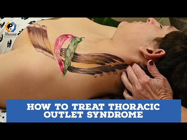 How to Treat Thoracic Outlet Syndrome