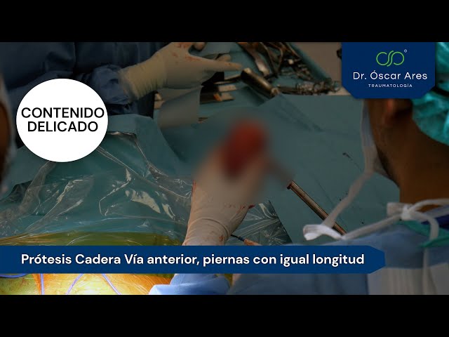 Prótesis Cadera Vía anterior piernas con igual longitud