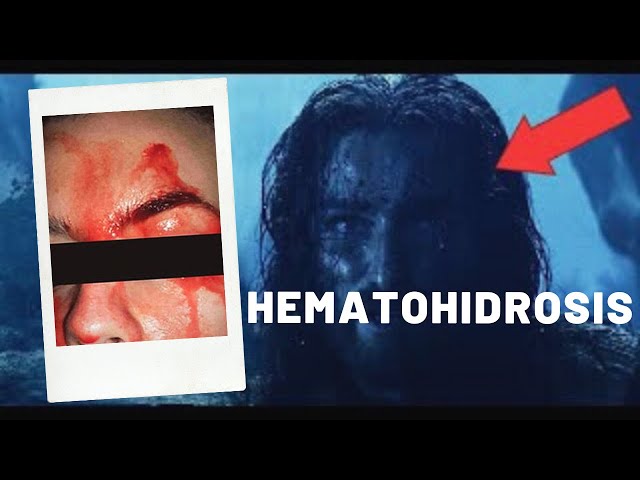 Hematohidrosis