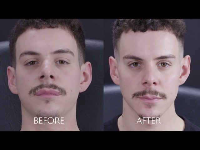 Dermal Fillers For Men