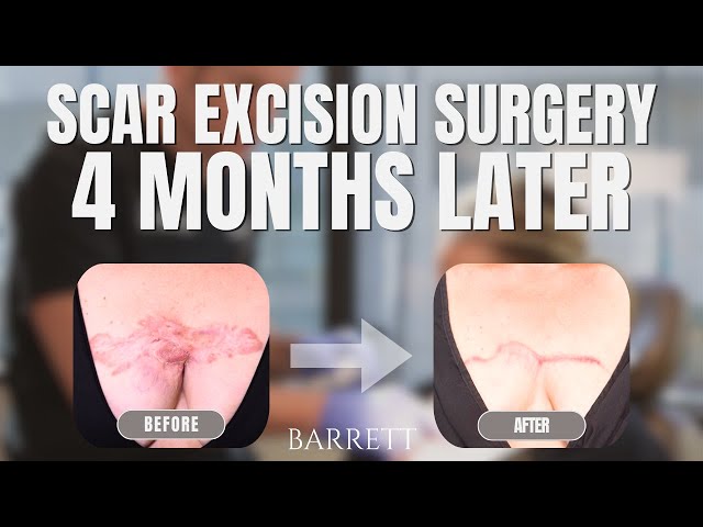 Amazing Scar Excision Surgery 4 Month's Post-Op! | Barrett Gives Back