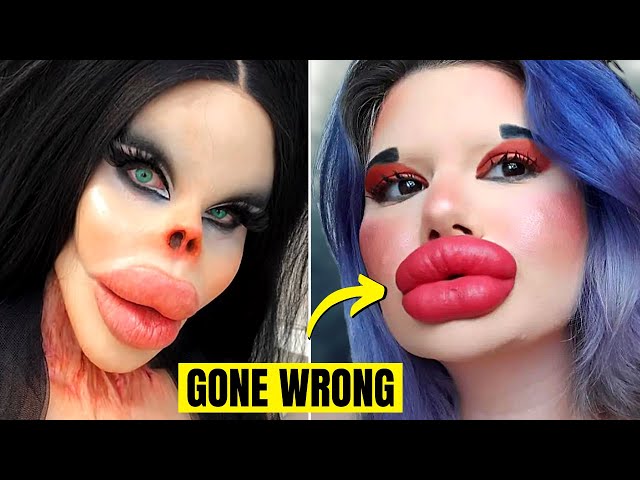 6 Times Plastic Surgery Went Horribly Wrong