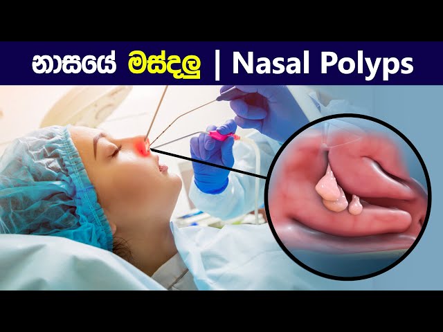 නාසයේ මස්දලු 😨| Nasal polyps and their treatment | How polypectomy is performed ? in sinhala