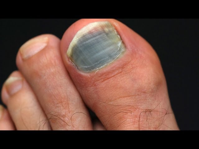 How to Prevent & Treat Black Toenail | Foot Care