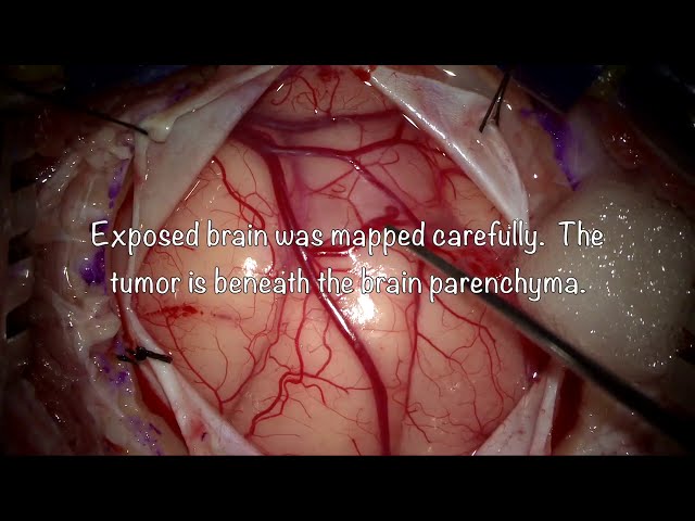 Brain tumor surgery: Aggressive Rhabdoid GBM near motor cortex in a young lady with paralysis.