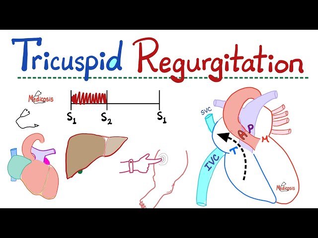 Tricuspid Regurgitation (TR) - Valvular Heart Disease (VHD) - Tricuspid Valve Insufficiency - Cardio