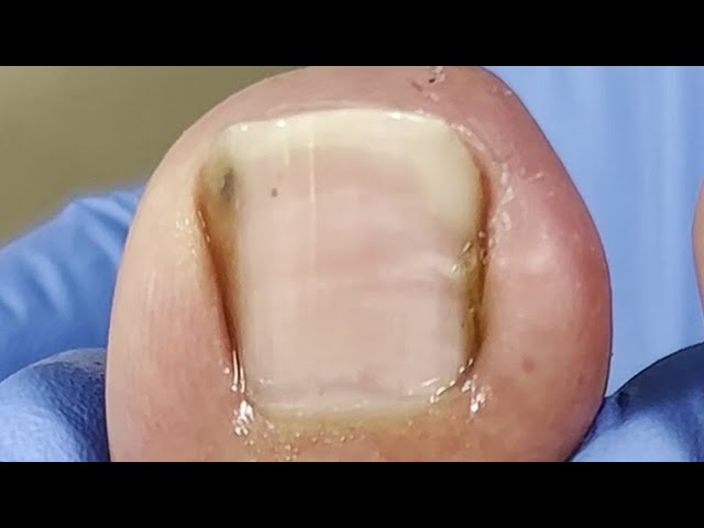 Perfectly trim long toenails and give it a good shape【Xue Yidao】