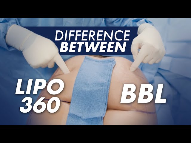 What is the Difference Between LIPO 360 and a BBL?