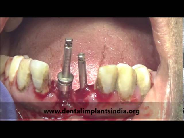 Immediate extraction and basal implant placement -implant procedure video