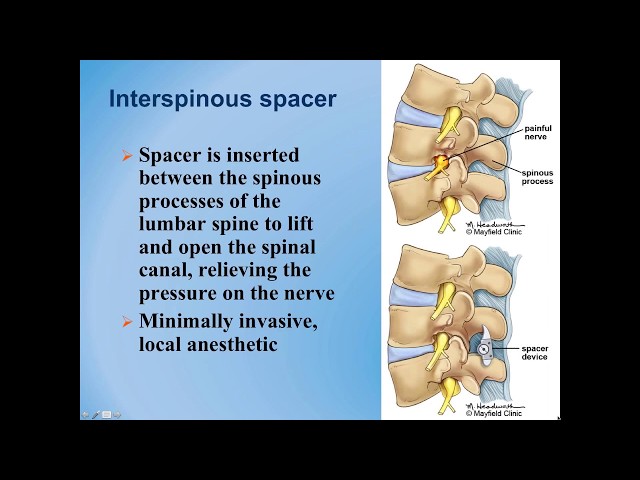 Lumbar Spinal Stenosis : Diagnosis and Treatment Options