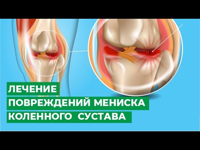 Лечение повреждений мениска коленного сустава