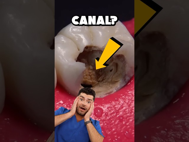 Root Canal Explained !?