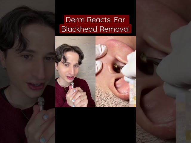 Ear Blackhead Removal. #dermreacts #shorts