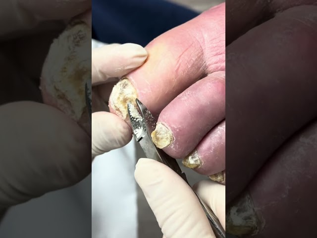 (Satisfying!) Crumbly Fungus-Filled Nail Cutting Transformation