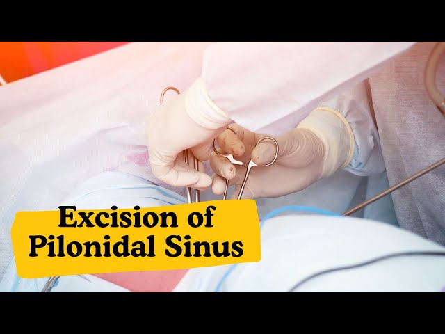 Excision of Pilonidal Sinus