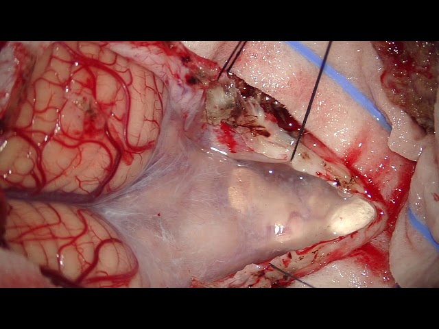 Telovelar approach microsurg resection of 4th ventricular subependymoma arising from rhomboid fossa