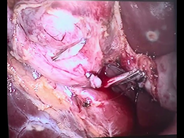 mucocele GB Laparoscopic cholecystectomy Mucocele gallbladder 2x unedited