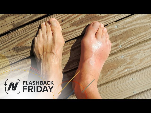 Flashback Friday: Treating Gout with Cherry Juice