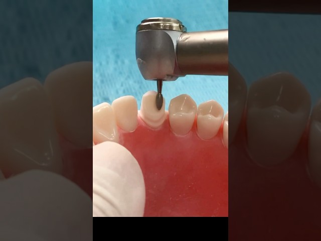 Crown preparation - Canine #teeth #teethstreet #dentalprocedure #dental