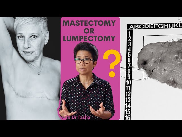 Mastectomy or lumpectomy? With Dr Tasha