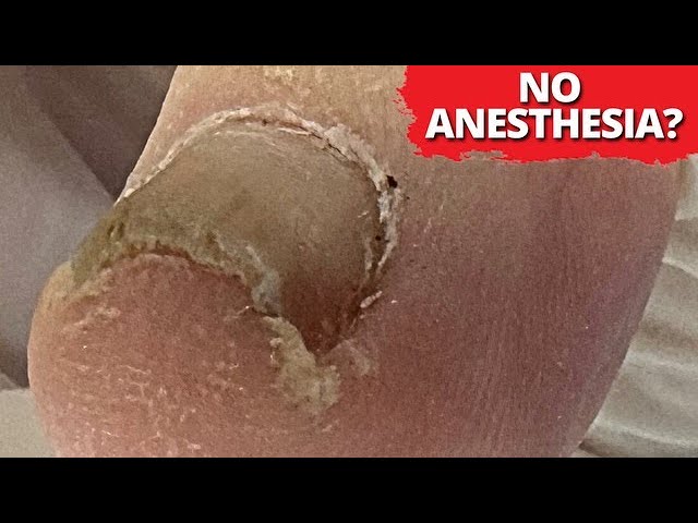 No Anesthesia?! 🤯 DEEP Ingrown Nail Removal