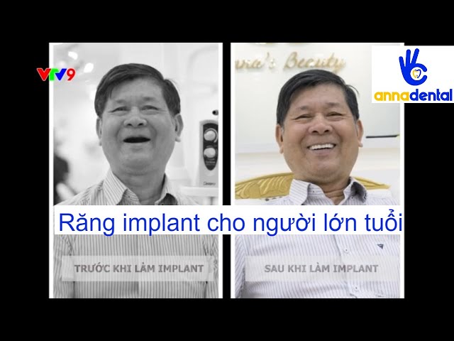 VTV9 Y KHOA HIỆN ĐẠI: NGƯỜI LỚN TUỔI MẤT RĂNG CẤY GHÉP IMPLANT TOÀN HÀM  ĐƯỢC KHÔNG | NHA KHOA ANNA