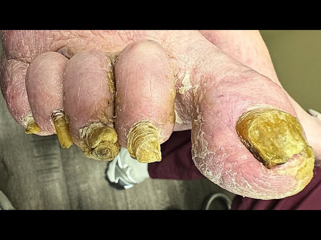 Cutting Thick Nails and Severe Callus Removal on a 90-Year-Old | Expert Foot Care Transformation