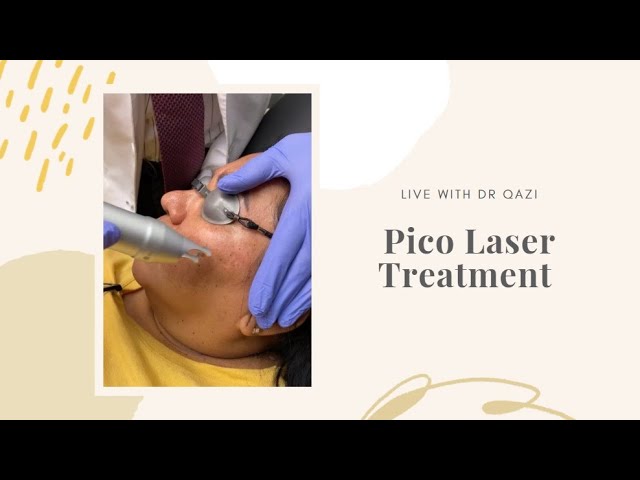 Pico Laser Treatment For Melasma LIVE!