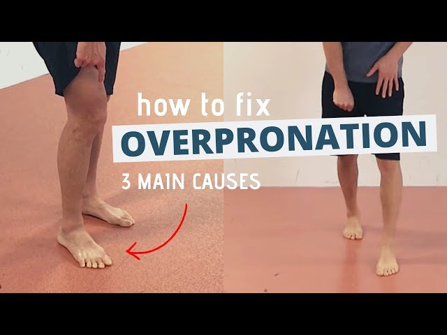 Pronated Feet and How to Fix 3 Different Causes of OVERPRONATION