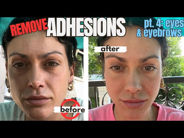 ADHESIONS: The glue your body makes that could be destroying your face | Pt. 3 Eyes & Eyebrows